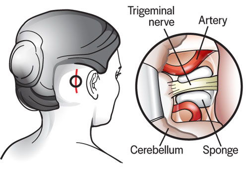 Microvascular Decompression