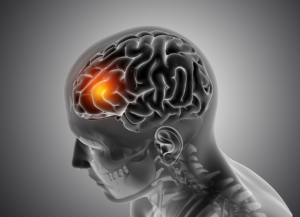 meningioma treatment gamma knife